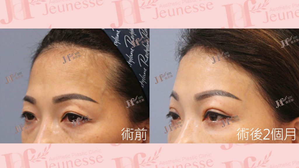 內視鏡前額七爪釘＋雙眼皮＋內開眼袋＋自體脂肪移植(淚溝)