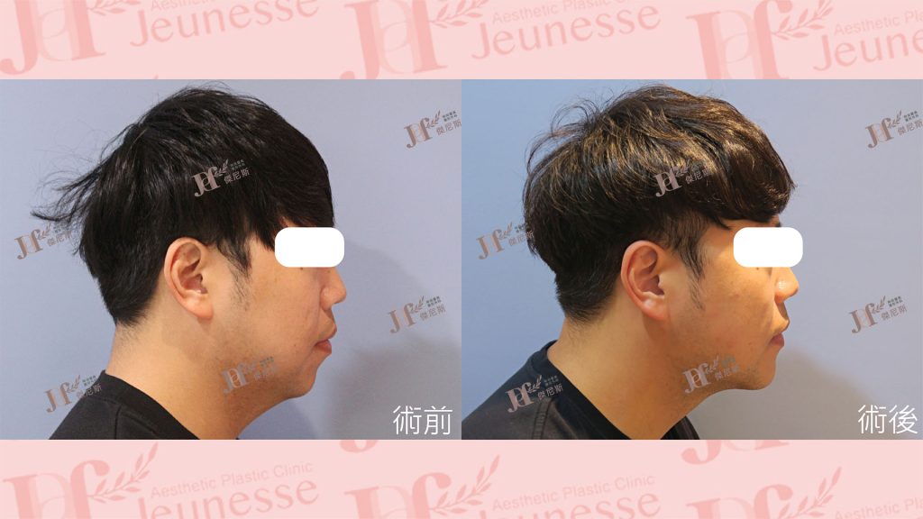 3D列印下巴＋天鵝頸手術