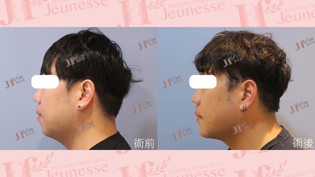 3D列印下巴＋天鵝頸手術