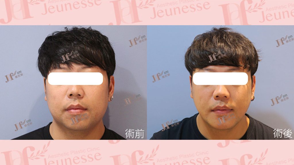 3D列印下巴＋天鵝頸手術