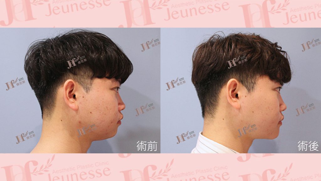 3D列印下巴＋天鵝頸手術