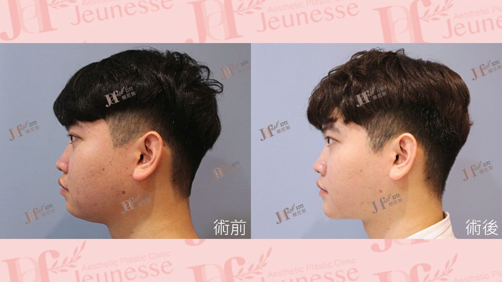 3D列印下巴＋天鵝頸手術