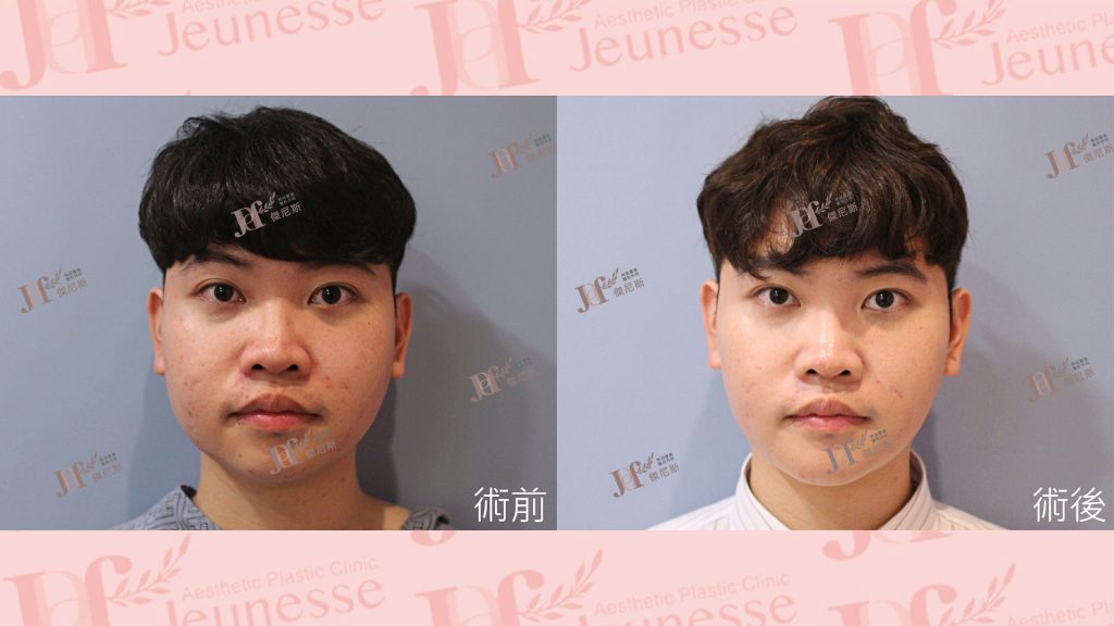 3D列印下巴＋天鵝頸手術