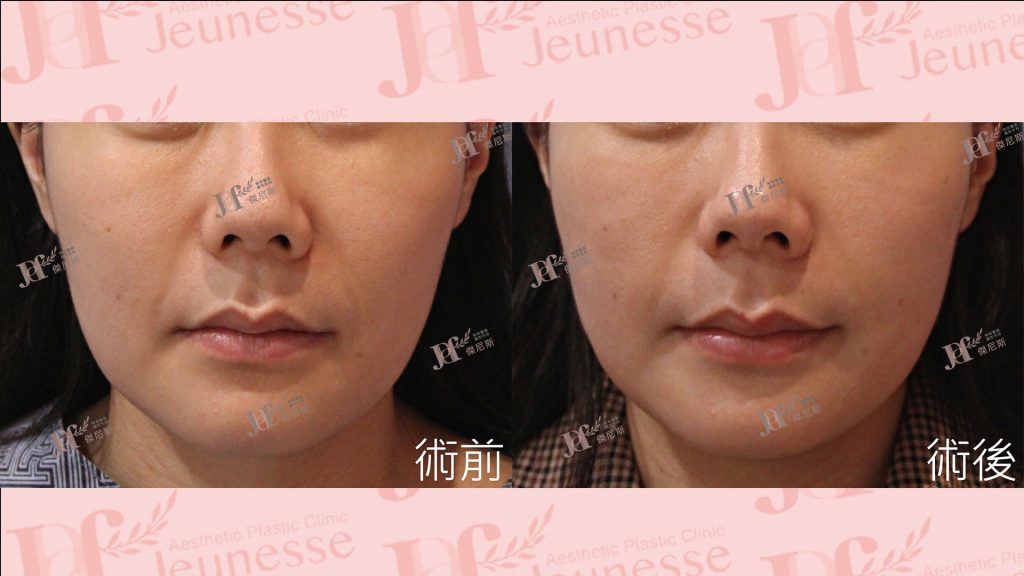 LSSA臉部精雕(眼袋補脂處＋蘋果肌下緣)＋自體脂肪移植(法令紋)