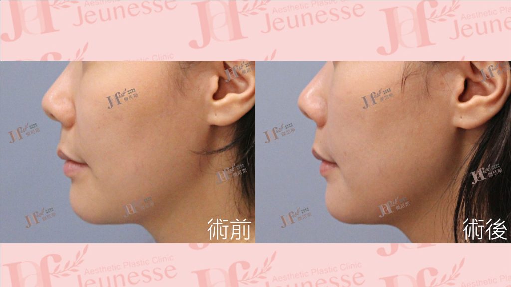 LSSA臉部精雕(眼袋補脂處＋蘋果肌下緣)＋自體脂肪移植(法令紋)