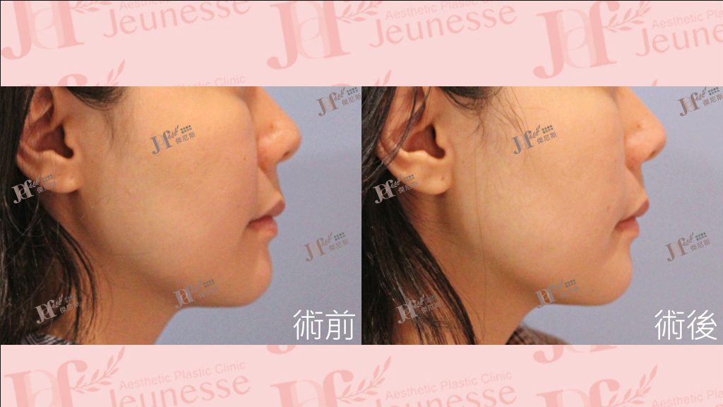 LSSA臉部精雕(眼袋補脂處＋蘋果肌下緣)＋自體脂肪移植(法令紋)