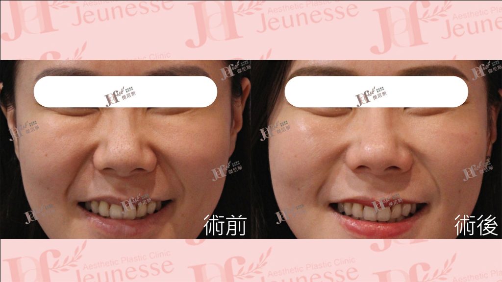 LSSA臉部精雕(眼袋補脂處＋蘋果肌下緣)＋自體脂肪移植(法令紋)