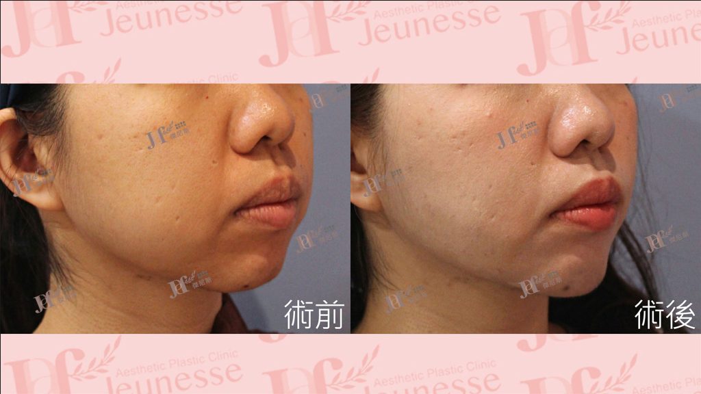 LSSA臉部精雕(眼袋補脂處＋蘋果肌下緣)＋自體脂肪移植(下巴)