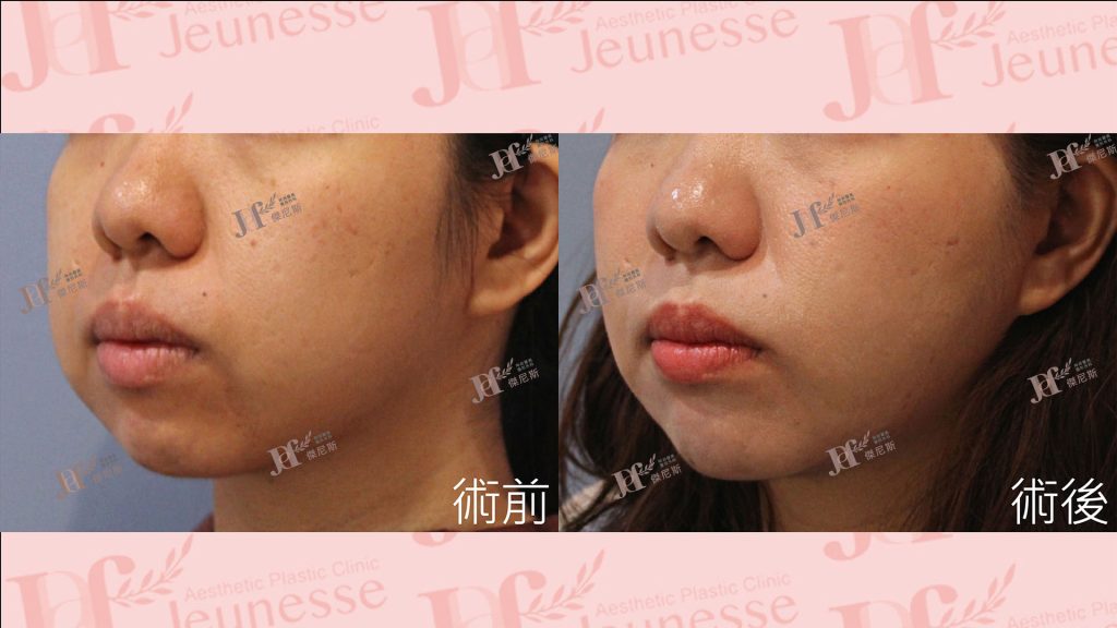 LSSA臉部精雕(眼袋補脂處＋蘋果肌下緣)＋自體脂肪移植(下巴)