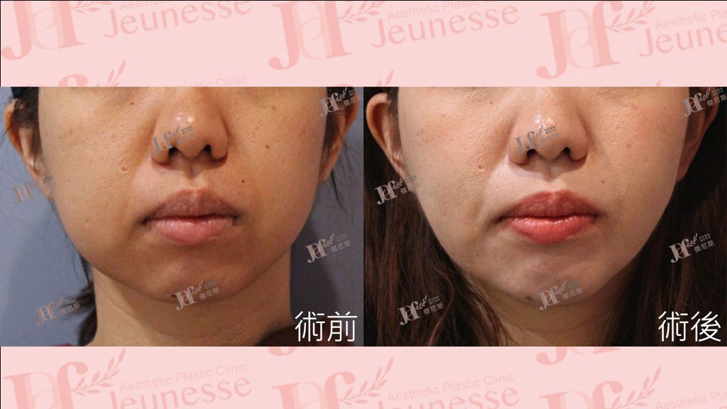 LSSA臉部精雕(眼袋補脂處＋蘋果肌下緣)＋自體脂肪移植(下巴)