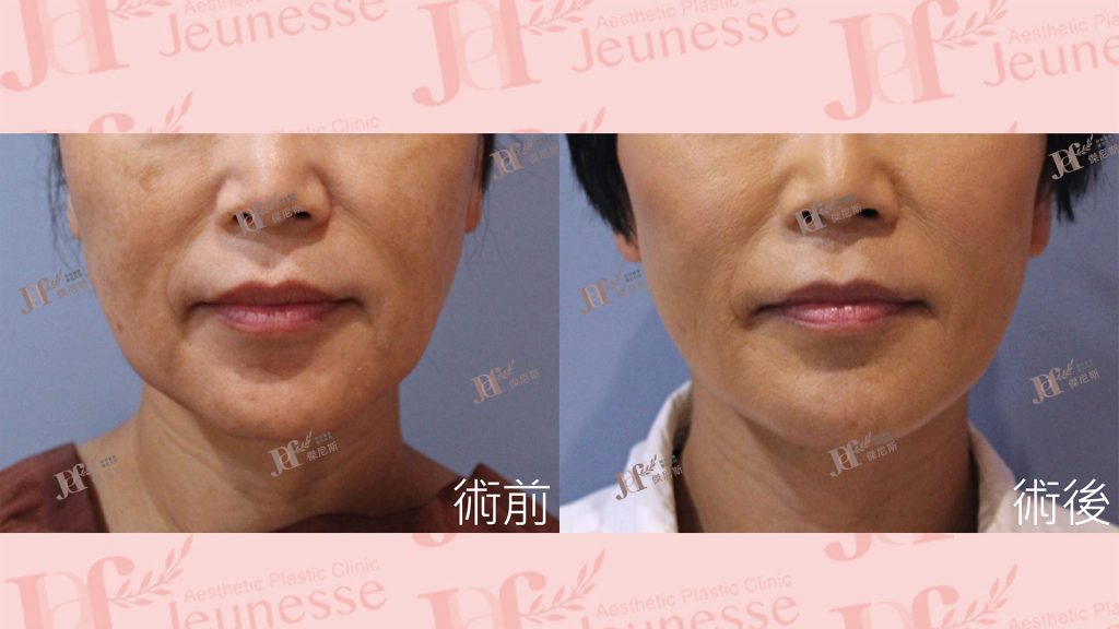 中下臉拉皮+自體脂肪移植(法令紋、木偶紋)