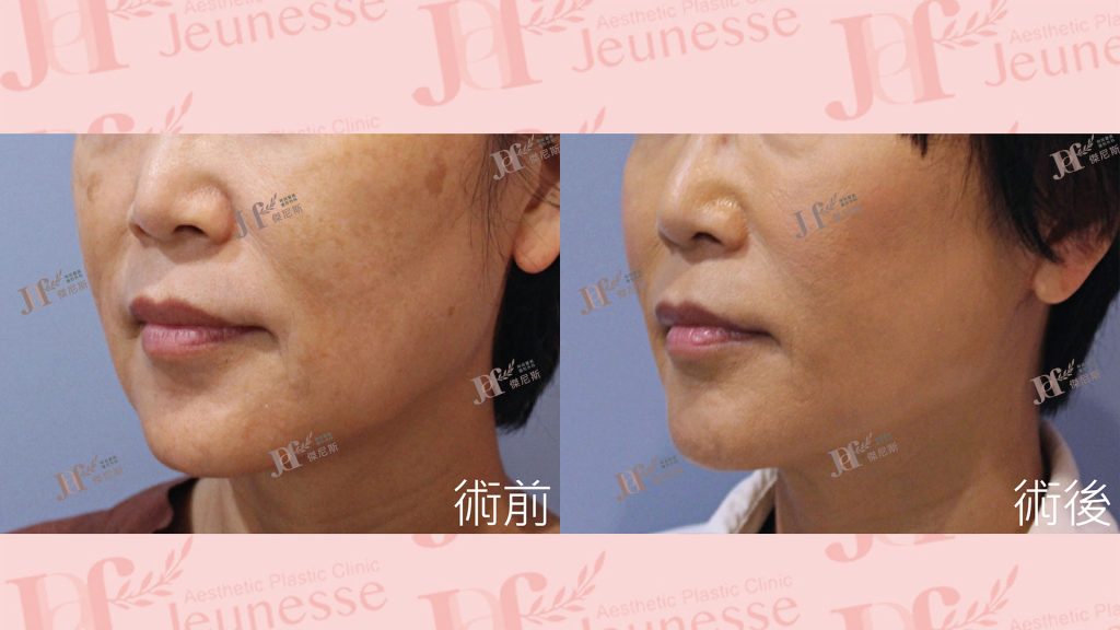 中下臉拉皮+自體脂肪移植(法令紋、木偶紋)