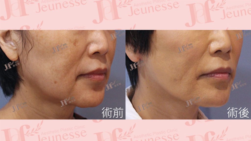 中下臉拉皮+自體脂肪移植(法令紋、木偶紋)