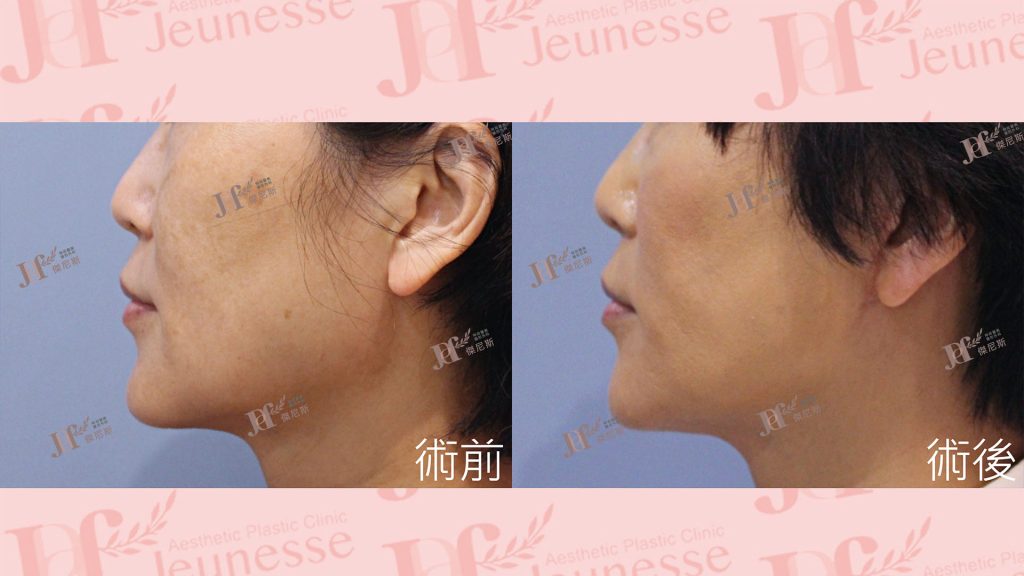 中下臉拉皮+自體脂肪移植(法令紋、木偶紋)