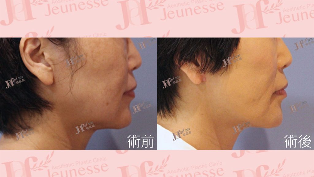 中下臉拉皮+自體脂肪移植(法令紋、木偶紋)