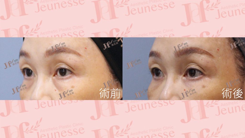 內開眼袋+外切皮+自體脂肪移植(淚溝、蘋果肌)