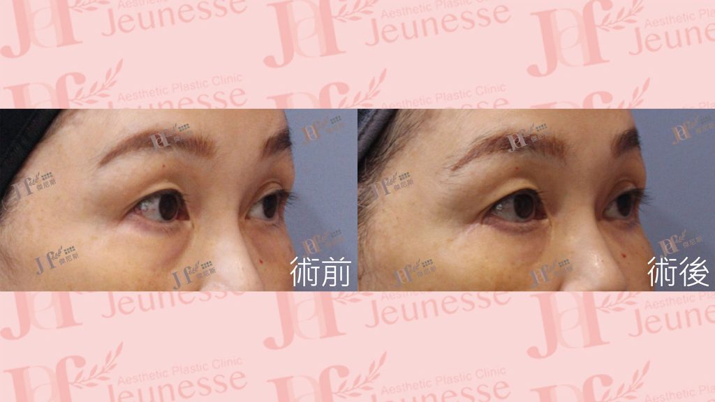 內開眼袋+外切皮+自體脂肪移植(淚溝、蘋果肌)