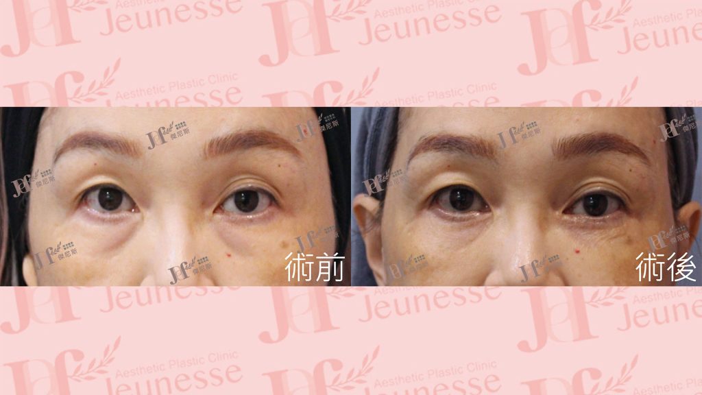 內開眼袋+外切皮+自體脂肪移植(淚溝、蘋果肌)