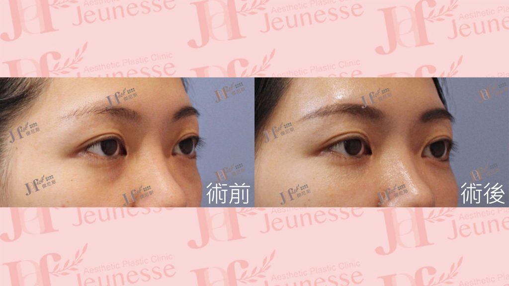 隱痕(內開)眼袋+自體脂肪移植(淚溝、蘋果肌)