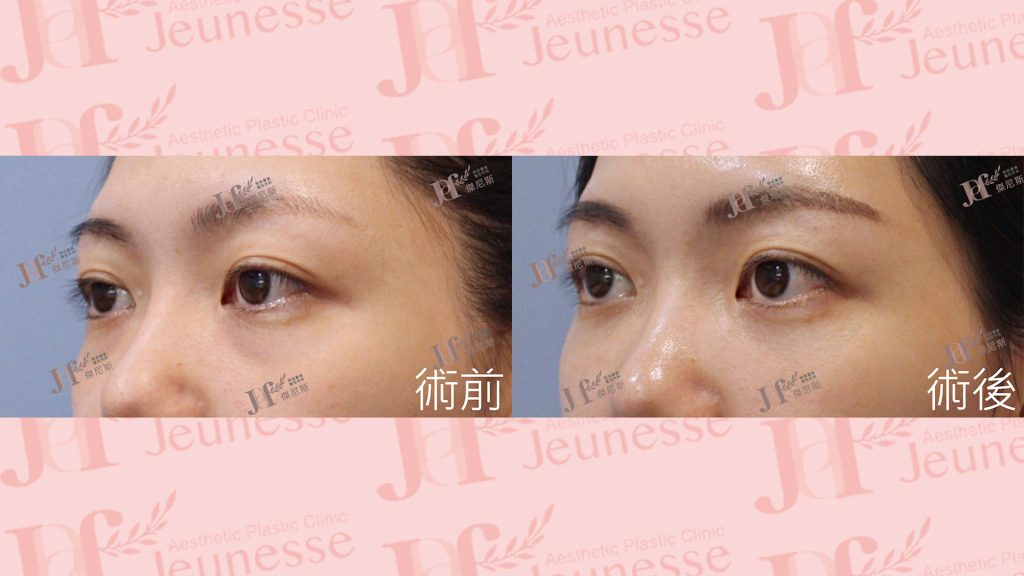 隱痕(內開)眼袋+自體脂肪移植(淚溝、蘋果肌)