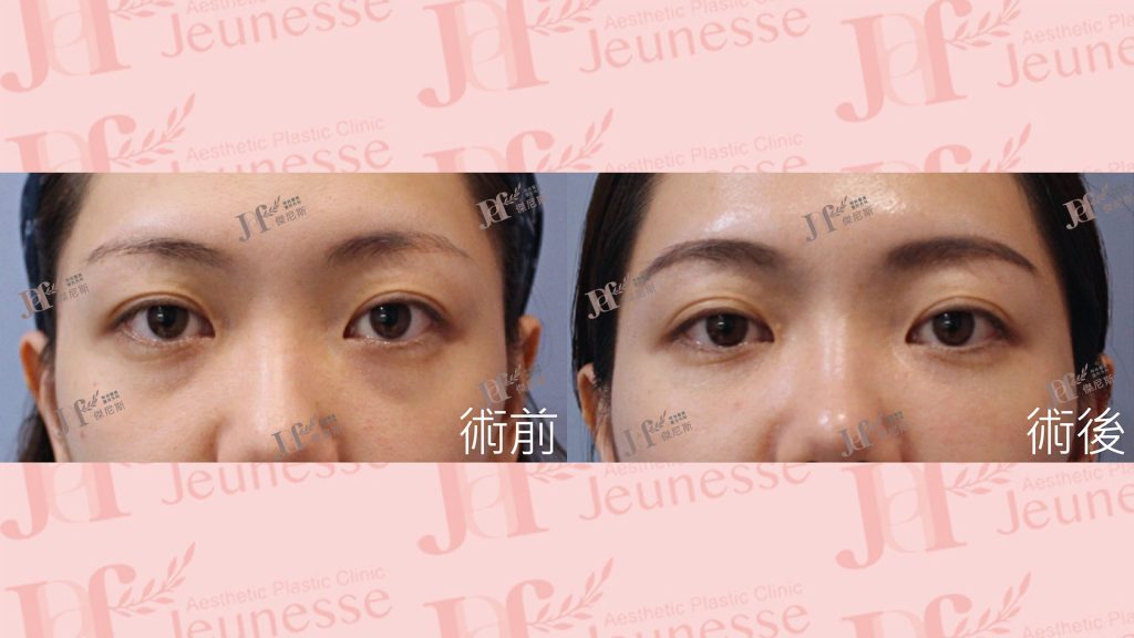 隱痕(內開)眼袋+自體脂肪移植(淚溝、蘋果肌)