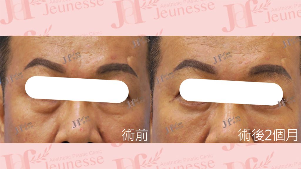 外開眼袋+自體脂肪移植(淚溝)