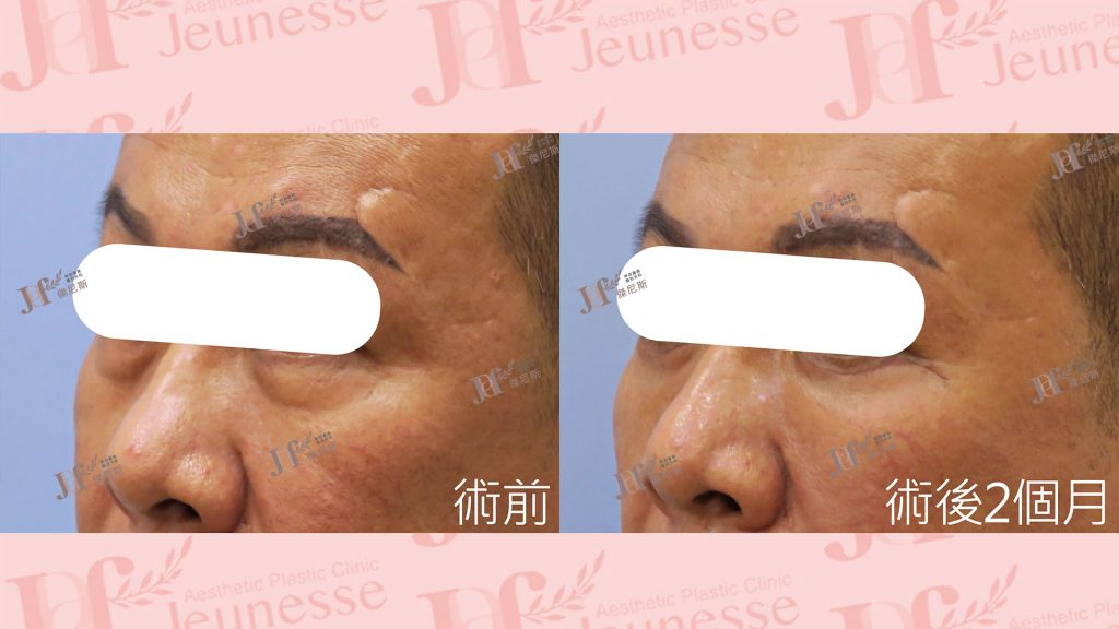 外開眼袋+自體脂肪移植(淚溝)