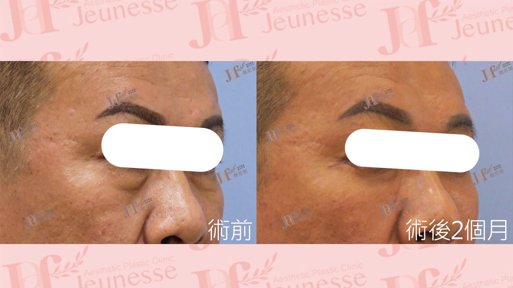 外開眼袋+自體脂肪移植(淚溝)