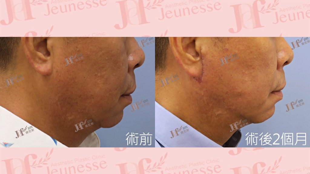 短疤痕SMAS筋膜層拉皮