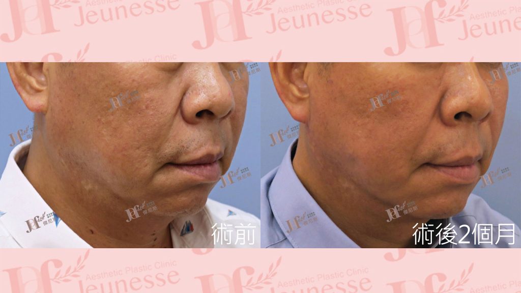 短疤痕SMAS筋膜層拉皮