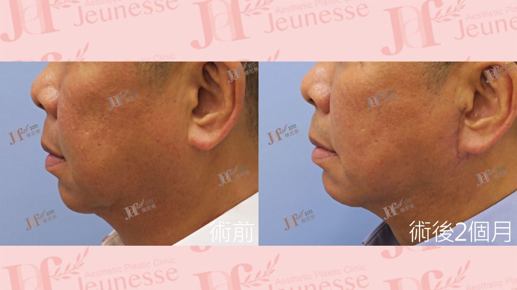 短疤痕SMAS筋膜層拉皮