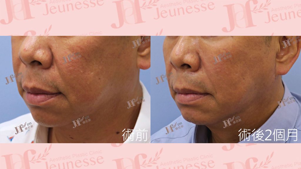 短疤痕SMAS筋膜層拉皮