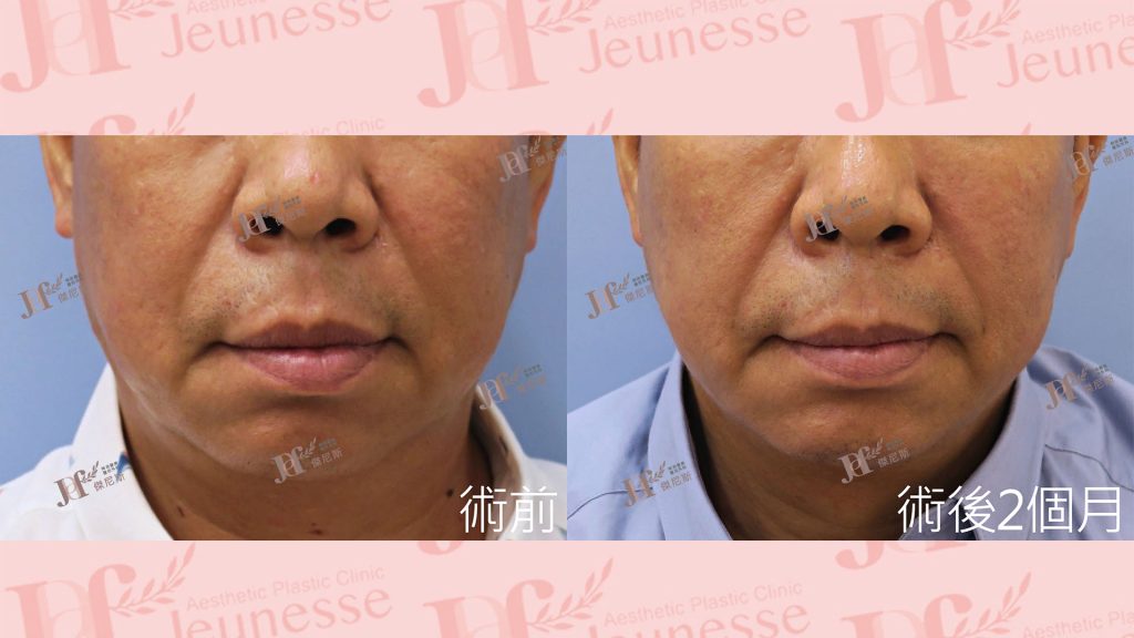 短疤痕SMAS筋膜層拉皮