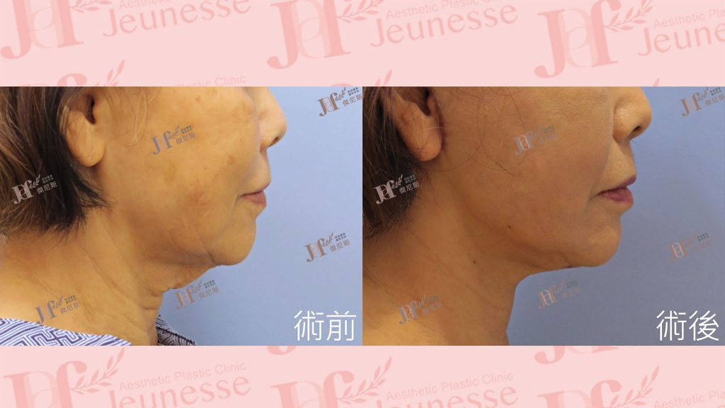 短疤痕SMAS筋膜層拉皮＋LSSA天鵝頸＋自體脂肪移植(火雞脖)