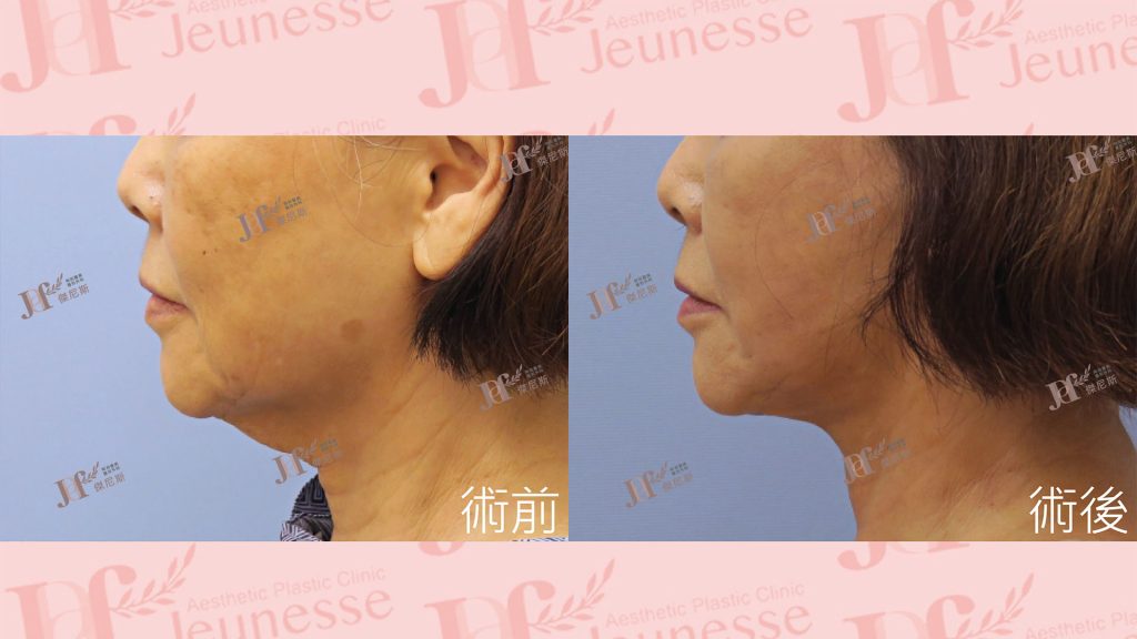 短疤痕SMAS筋膜層拉皮＋LSSA天鵝頸＋自體脂肪移植(火雞脖)