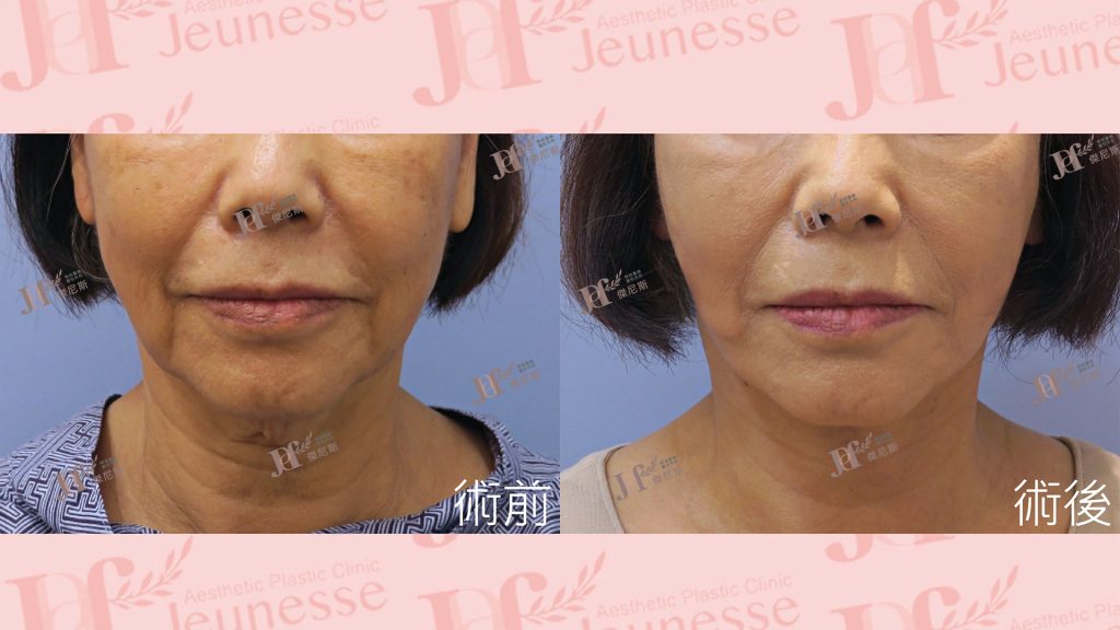 短疤痕SMAS筋膜層拉皮＋LSSA天鵝頸＋自體脂肪移植(火雞脖)