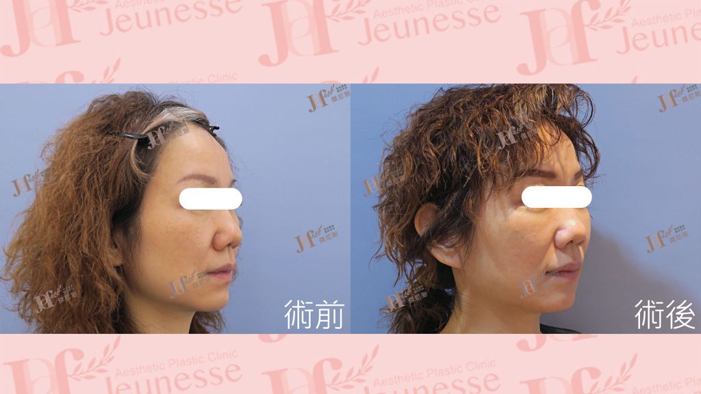 短疤痕SMAS筋膜層拉皮＋外開眼袋＋自體脂肪移植(淚溝、法令紋)