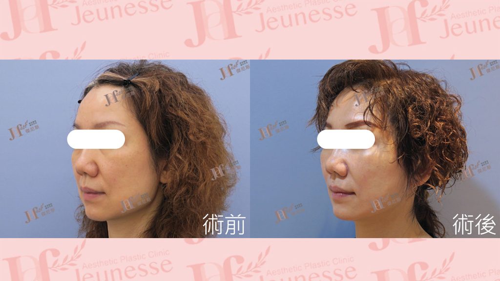 短疤痕SMAS筋膜層拉皮＋外開眼袋＋自體脂肪移植(淚溝、法令紋)