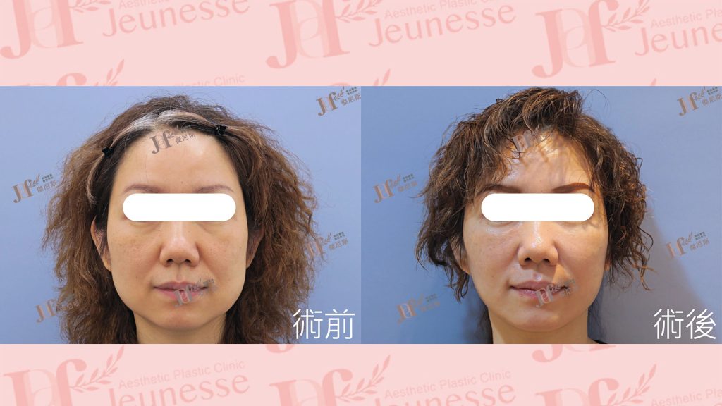 短疤痕SMAS筋膜層拉皮＋外開眼袋＋自體脂肪移植(淚溝、法令紋)