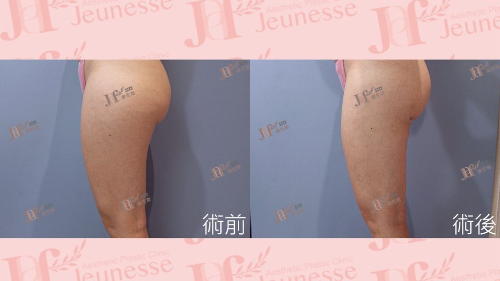 超能電漿Z＋超音波抽脂(大腿環抽)