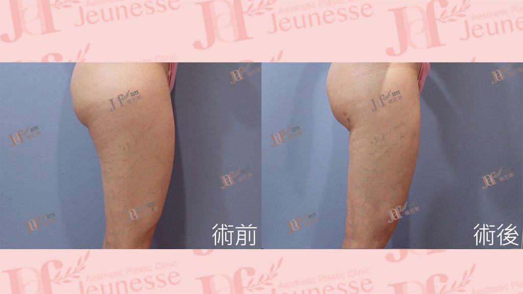 超能電漿Z＋超音波抽脂(大腿環抽)