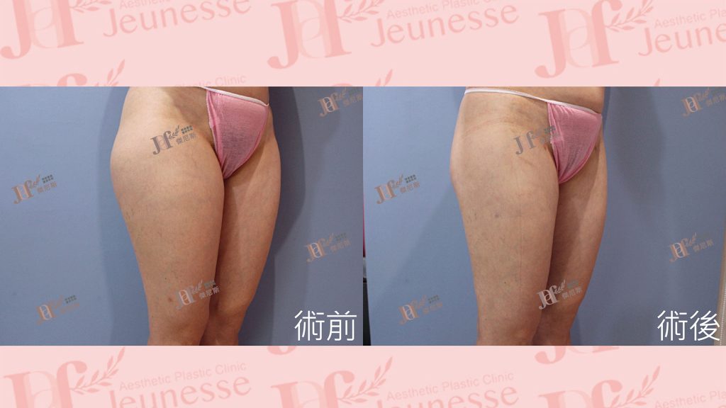 超能電漿Z＋超音波抽脂(大腿環抽)