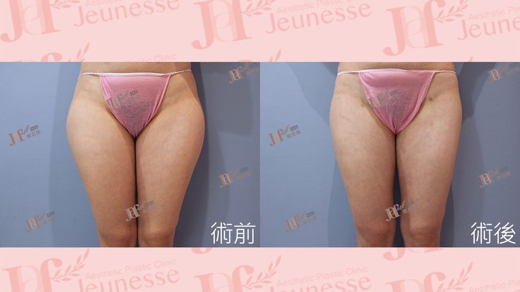 超能電漿Z＋超音波抽脂(大腿環抽)