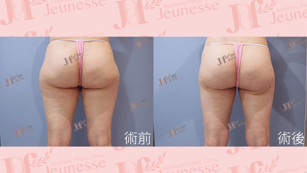 超能電漿Z＋超音波抽脂(大腿環抽)